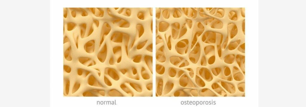 osteoporose-botplus