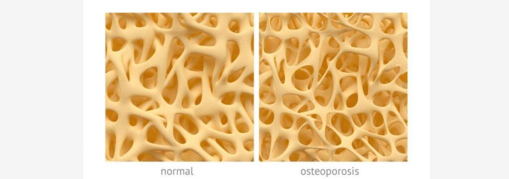 osteoporose-botplus osteoporose-botplus